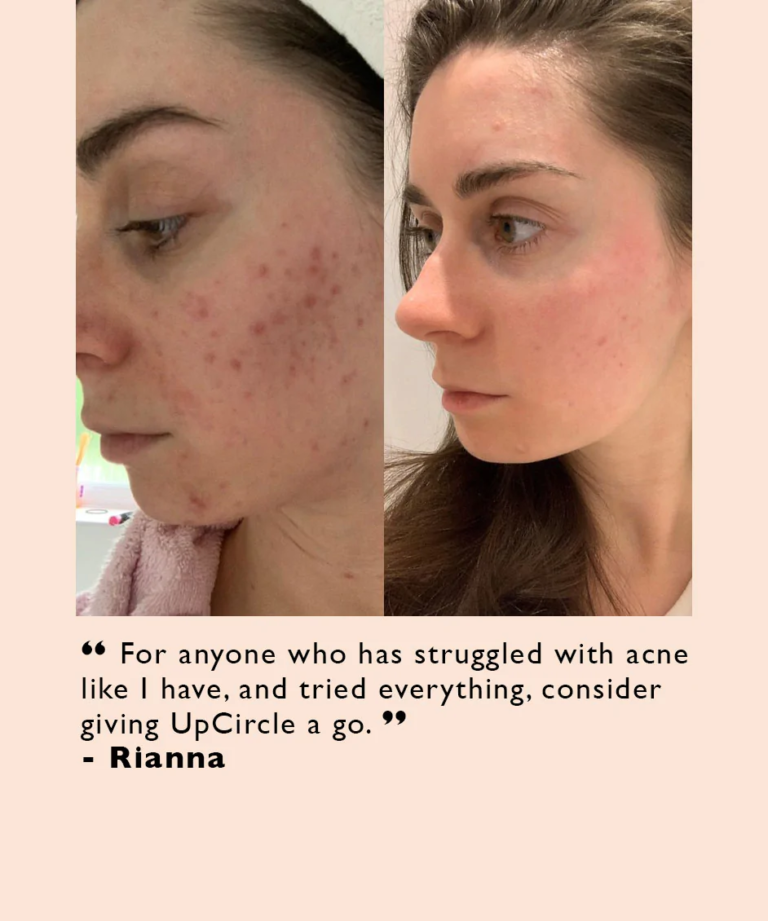 UpCircle Acne-Attacker Set thumbnail 2